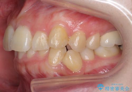 歯並びのがたつきを直したい ワイヤーは嫌 抜きたくないの治療前
