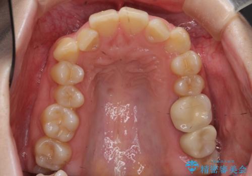 歯並びのがたつきを直したい ワイヤーは嫌 抜きたくないの治療前