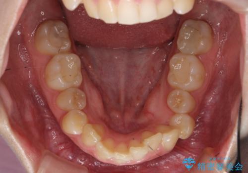 歯並びのがたつきを直したい ワイヤーは嫌 抜きたくないの治療前