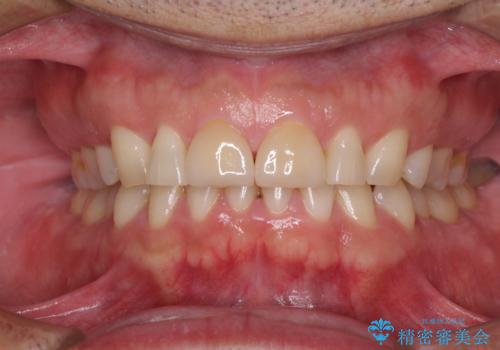 前歯の隙間を閉じたい　ラミネートベニアによる審美歯科治療の治療後