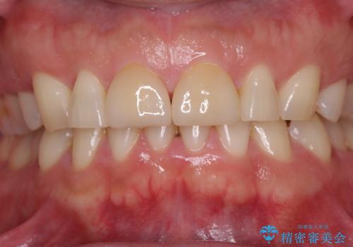 前歯の隙間を閉じたい　ラミネートベニアによる審美歯科治療