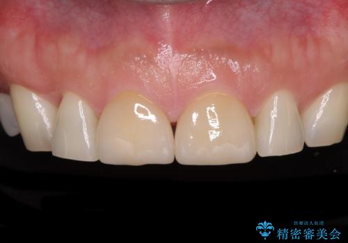 前歯の隙間を閉じたい　ラミネートベニアによる審美歯科治療の症例 治療後