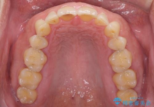 前歯の隙間を閉じたい　ラミネートベニアによる審美歯科治療の治療後