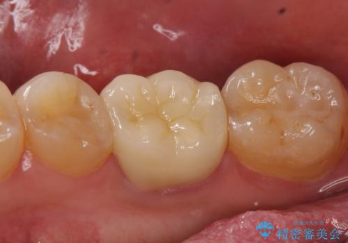 オールセラミッククラウン 鈍い痛みが続く奥歯の治療の治療後