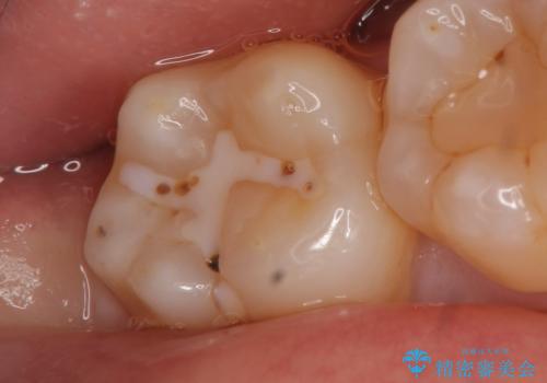 セラミックインレー 冷たいものがしみる奥歯の治療の症例 治療前