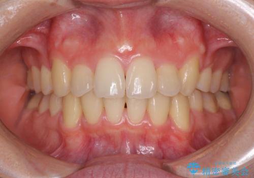 気になる八重歯を治したい ワイヤー装置での抜歯矯正の症例 治療後