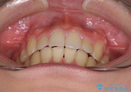 気になる八重歯を治したい ワイヤー装置での抜歯矯正の治療後