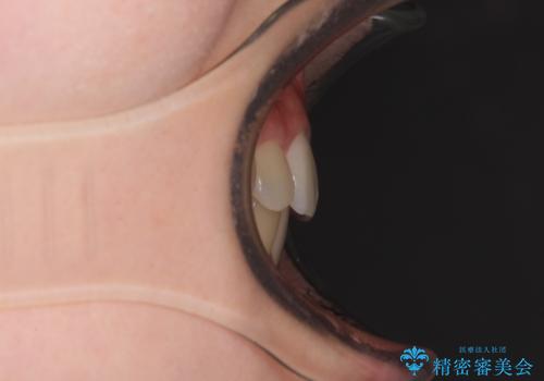 気になる八重歯を治したい ワイヤー装置での抜歯矯正の治療後