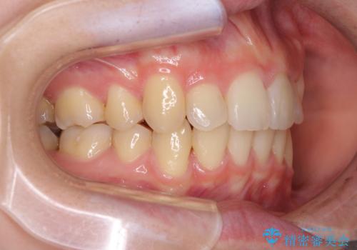 気になる八重歯を治したい ワイヤー装置での抜歯矯正の治療後