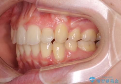 気になる八重歯を治したい ワイヤー装置での抜歯矯正の治療後