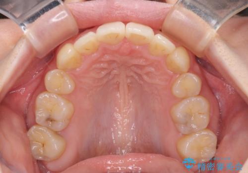 気になる八重歯を治したい ワイヤー装置での抜歯矯正の治療後