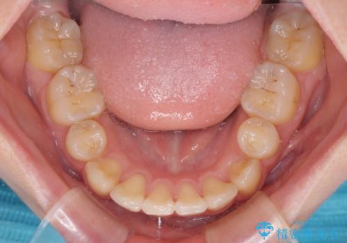 気になる八重歯を治したい ワイヤー装置での抜歯矯正の治療後