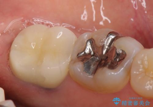 オールセラミッククラウン 咬むと痛む奥歯の治療の治療後