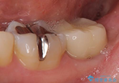 オールセラミッククラウン 咬むと痛む奥歯の治療の治療後