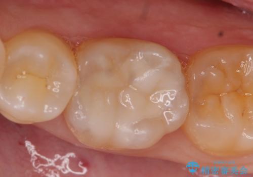 セラミックインレー しみる奥歯の治療の症例 治療後