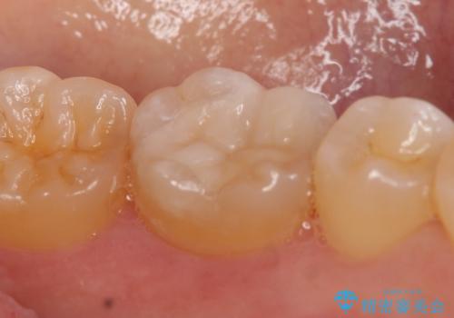 セラミックインレー しみる奥歯の治療の治療後