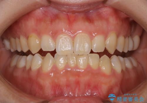 Whitening前のクリーニングの治療前
