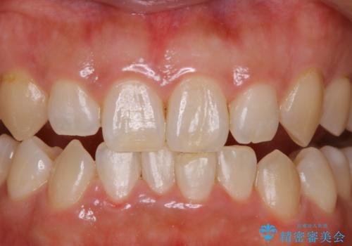 Whitening前のクリーニングの治療後