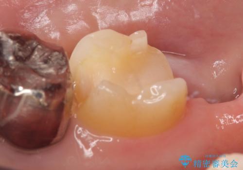 PGA(ゴールド)インレー しみる銀歯の虫歯治療の治療中