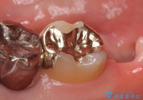 PGA(ゴールド)インレー　しみる銀歯の虫歯治療の治療後