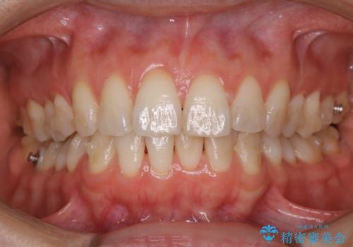 invisalign中のクリーニング