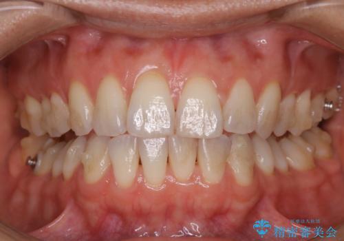invisalign中のクリーニングの治療前