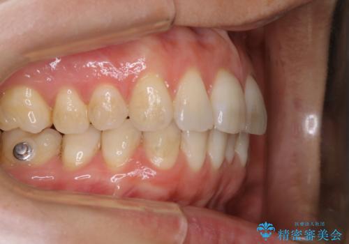invisalign中のクリーニングの治療前