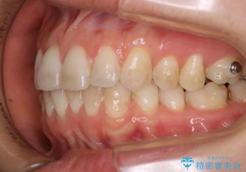 invisalign中のクリーニングの治療前