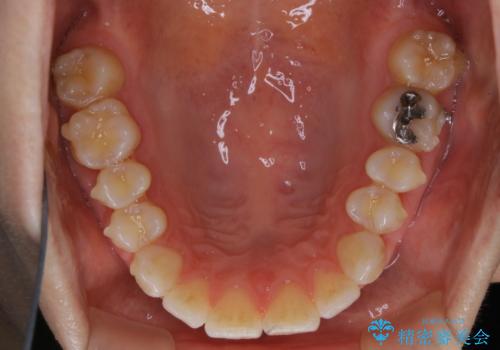 invisalign中のクリーニングの治療前