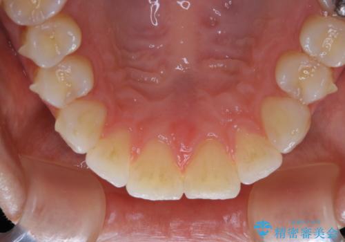 invisalign中のクリーニングの治療前