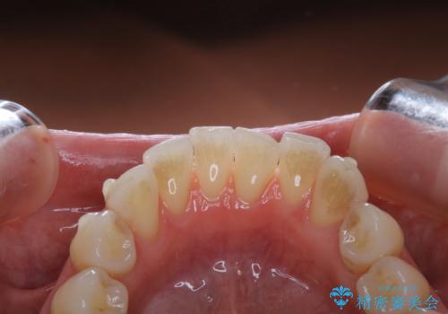 invisalign中のクリーニングの治療前