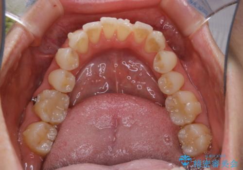 invisalign中のクリーニングの治療前