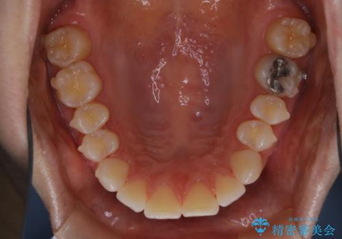 invisalign中のクリーニングの治療後