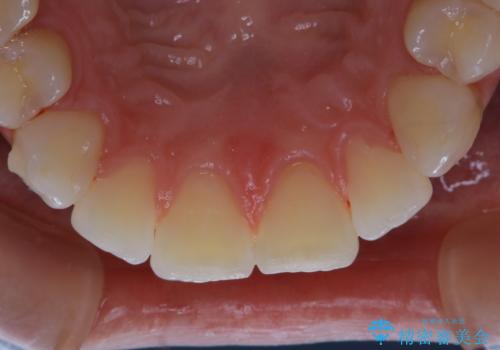 invisalign中のクリーニングの治療後
