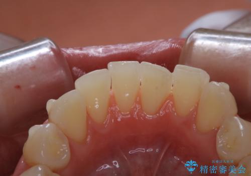 invisalign中のクリーニングの治療後