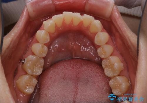 invisalign中のクリーニングの治療後