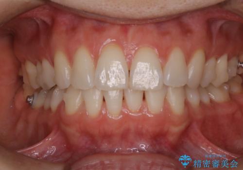 invisalign中のクリーニングの症例 治療後