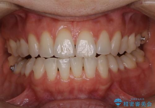 invisalign中のクリーニングの治療後