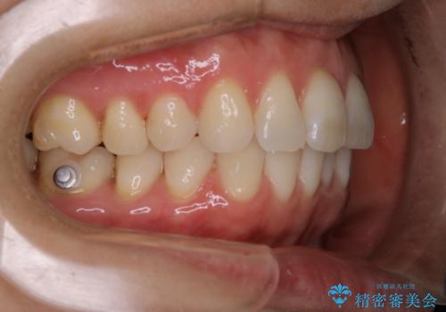 invisalign中のクリーニングの治療後