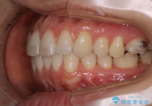 invisalign中のクリーニングの治療後