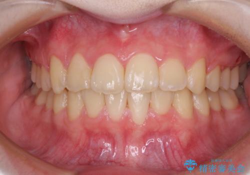 前歯をきれいに整えたい　ワイヤー装置での非抜歯矯正の症例 治療後