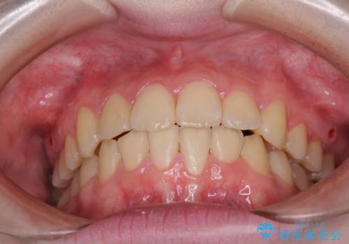 前歯をきれいに整えたい ワイヤー装置での非抜歯矯正の治療後