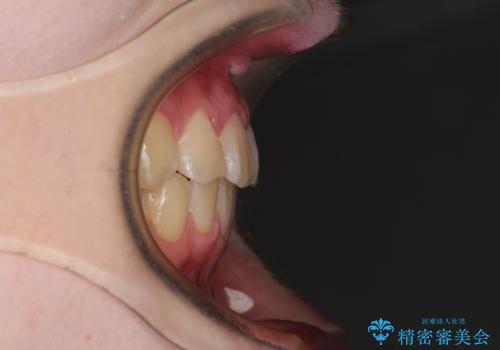 前歯をきれいに整えたい ワイヤー装置での非抜歯矯正の治療後