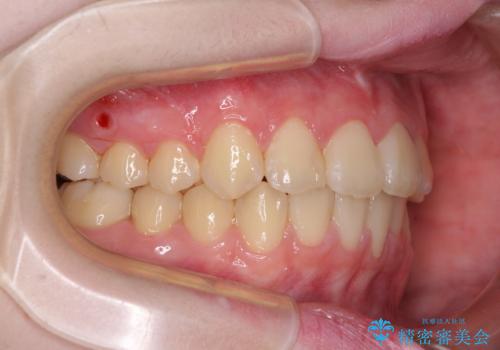 前歯をきれいに整えたい ワイヤー装置での非抜歯矯正の治療後