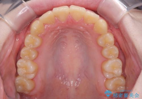 前歯をきれいに整えたい ワイヤー装置での非抜歯矯正の治療後