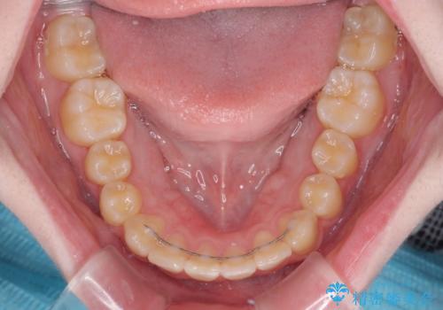 前歯をきれいに整えたい　ワイヤー装置での非抜歯矯正の治療後