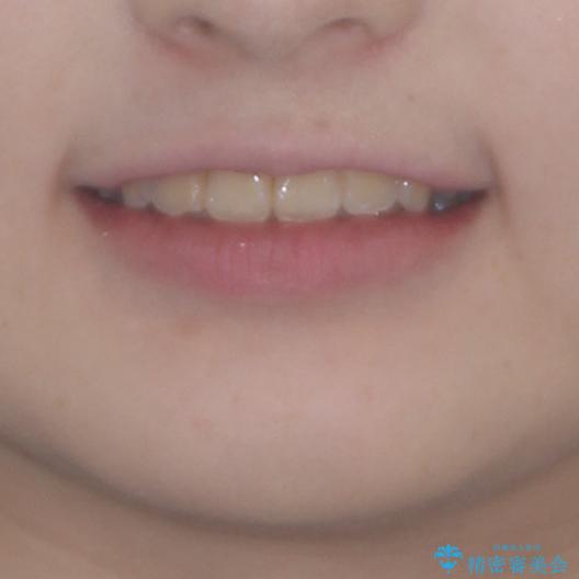 前歯をきれいに整えたい　ワイヤー装置での非抜歯矯正の治療後（顔貌）