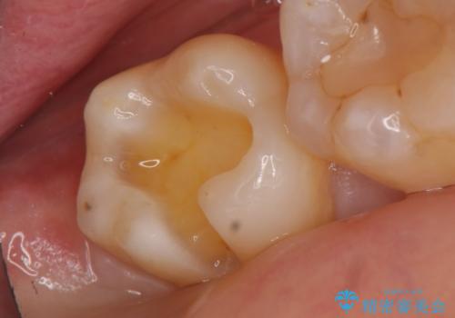 セラミックインレー 冷たいものがしみる奥歯の治療の治療中