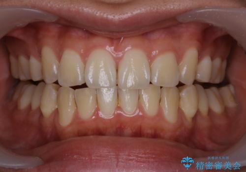 マスクをすると口臭が気になるの症例 治療前