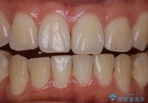 マスクをすると口臭が気になるの治療前